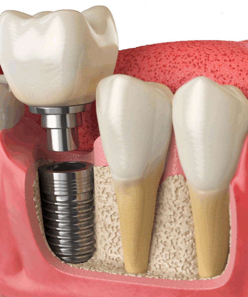 Implantes All-on-Six en Valdivia: sonrisa fija con solo 6 implantes